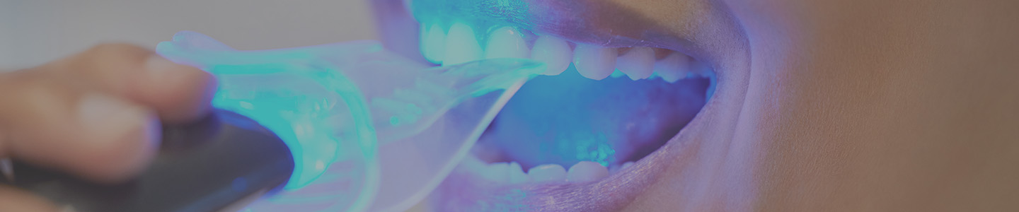 Teeth Whitening In Alpharetta, GA | Midway Family And Cosmetic Dentistry